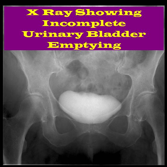 Incomplete Bladder Emptying Incomplete Bladder Emptying